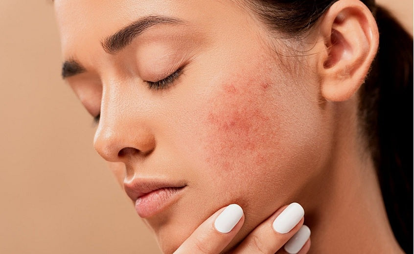 Acné fongique : causes, symptômes et solutions efficaces