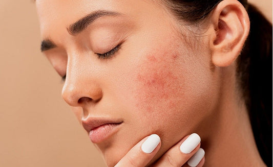 Acné fongique : causes, symptômes et solutions efficaces